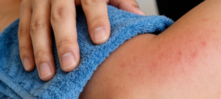 汤立新主任：教你5个方法，缓解带状疱疹神经痛！