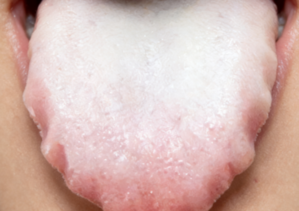 舌苔两边有齿痕就是脾虚、湿气重？搞清4点原因，教你 4个方法对症调